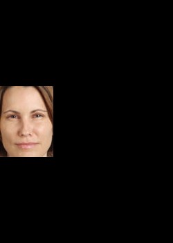 After Image: Botox® Cosmetic Patient 2 - front