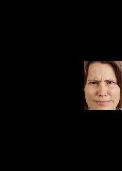 Before Image: Botox® Cosmetic Patient 2 - front
