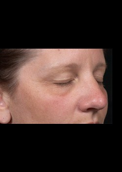After Image: Clear and Brilliant® Patient 1 - right-front-oblique