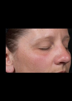 Before Image: Clear and Brilliant® Patient 1 - right-front-oblique