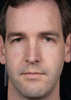 Before Image: Clear and Brilliant® Patient 2 - front