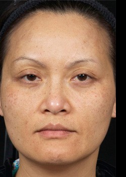 After Image: Clear and Brilliant® Patient 3 - front