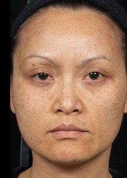 Before Image: Clear and Brilliant® Patient 3 - front