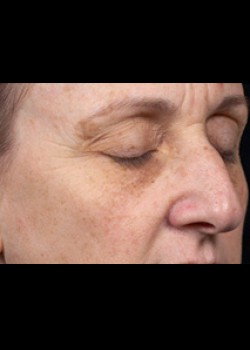 After Image: Clear and Brilliant® Patient 4 - right-front-oblique