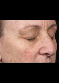 Before Image: Clear and Brilliant® Patient 4 - right-front-oblique