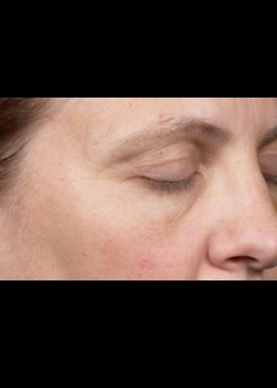 After Image: Clear and Brilliant® Patient 6 - right-front-oblique