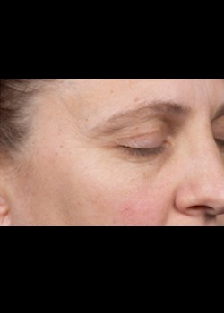 Before Image: Clear and Brilliant® Patient 6 - right-front-oblique
