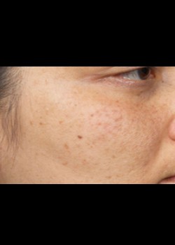 After Image: Clear and Brilliant® Patient 7 - other