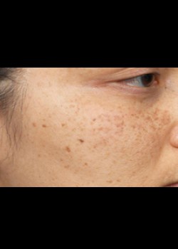 Before Image: Clear and Brilliant® Patient 7 - other