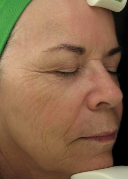 After Image: Fraxel® Dual Patient 1 - right-front-oblique