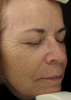 Before Image: Fraxel® Dual Patient 1 - right-front-oblique