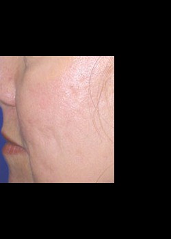 After Image: Fraxel® Dual Patient 2 - other