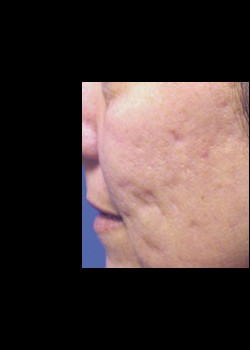 Before Image: Fraxel® Dual Patient 2 - other