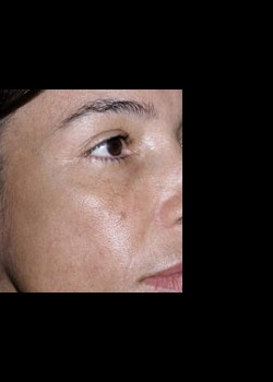 After Image: Fraxel® Dual Patient 3 - right-front-oblique