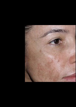Before Image: Fraxel® Dual Patient 3 - right-front-oblique