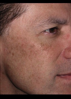 Before Image: Fraxel® Dual Patient 5 - other