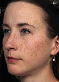 Before Image: Fraxel® Dual Patient 6 - left-front-oblique