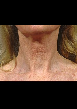 After Image: Fraxel® Dual Patient 7 - front