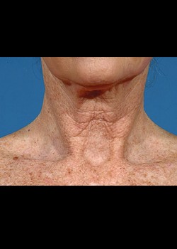 Before Image: Fraxel® Dual Patient 7 - front