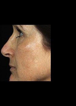After Image: Fraxel® Dual Patient 8 - other