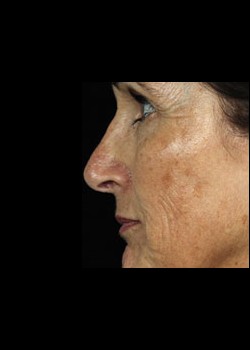 Before Image: Fraxel® Dual Patient 8 - other