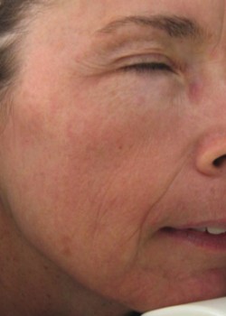 After Image: Fraxel® Dual Patient 9 - other