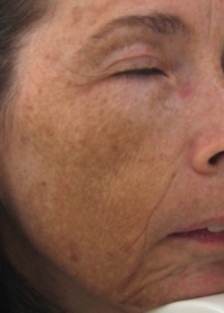 Before Image: Fraxel® Dual Patient 9 - other