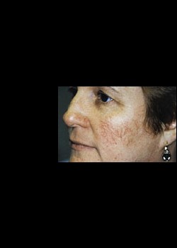 Intense Pulsed Light™ Treatment Patient 2