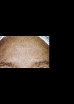 After Image: Intense Pulsed Light™ Treatment Patient 3 - other