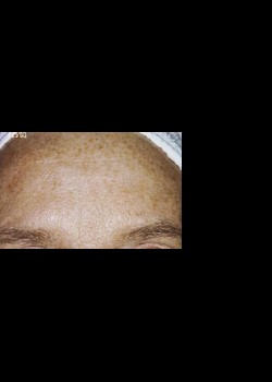 Intense Pulsed Light™ Treatment Patient 3