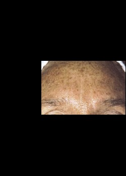 Before Image: Intense Pulsed Light™ Treatment Patient 3 - other
