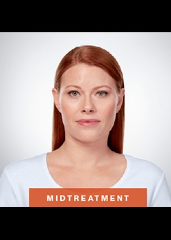 After Image: Kybella® Patient 1 - front