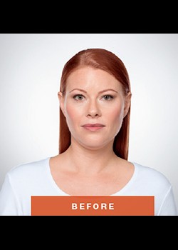 Before Image: Kybella® Patient 1 - front