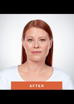 After Image: Kybella® Patient 1 - front