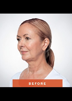 Before Image: Kybella® Patient 2 - left-front-oblique