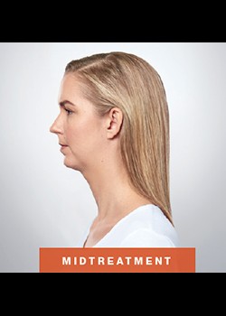 After Image: Kybella® Patient 3 - other