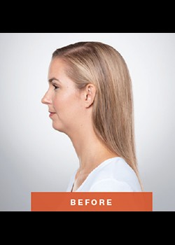 Before Image: Kybella® Patient 3 - other