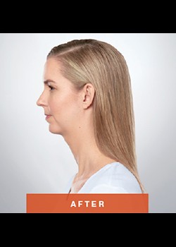 After Image: Kybella® Patient 3 - other