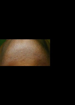 After Image: Laser Hair Removal Patient 1 - other