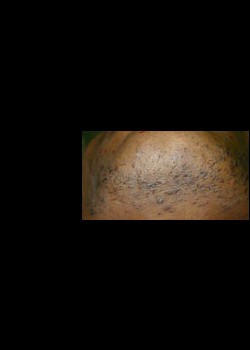 Before Image: Laser Hair Removal Patient 1 - other