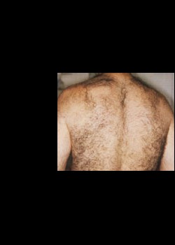 Before Image: Laser Hair Removal Patient 2 - back