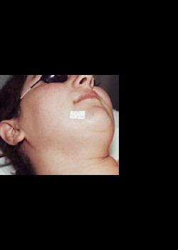 After Image: Laser Hair Removal Patient 3 - other