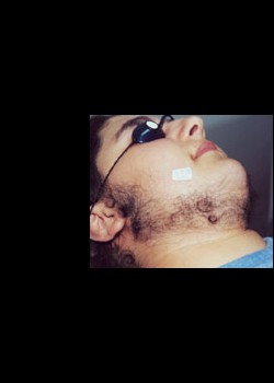 Before Image: Laser Hair Removal Patient 3 - other