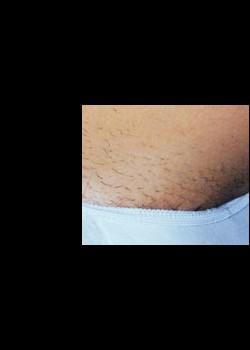 Before Image: Laser Hair Removal Patient 4 - other