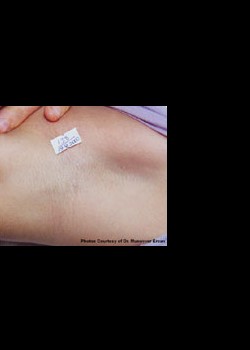 After Image: Laser Hair Removal Patient 5 - other