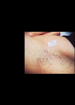 Before Image: Laser Hair Removal Patient 5 - other