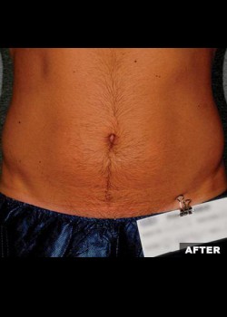 After Image: Liposonix® Patient 1 - front