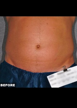 Before Image: Liposonix® Patient 1 - front