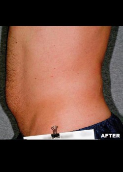 After Image: Liposonix® Patient 2 - other