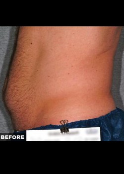 Before Image: Liposonix® Patient 2 - other